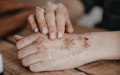 A Practical Guide to Natural Dermatitis Treatment